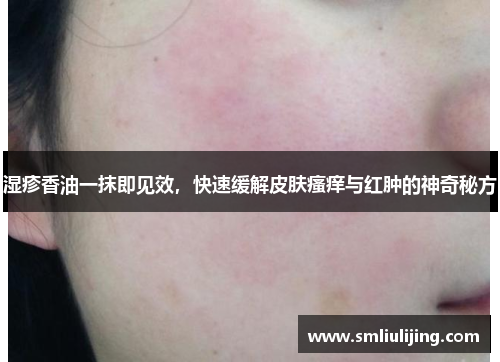 湿疹香油一抹即见效,快速缓解皮肤瘙痒与红肿的神奇秘方